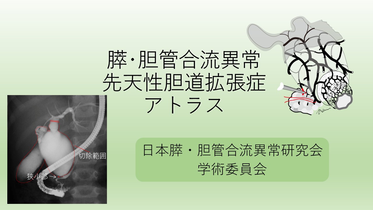 膵･胆管合流異常 先天性胆道拡張症アトラス